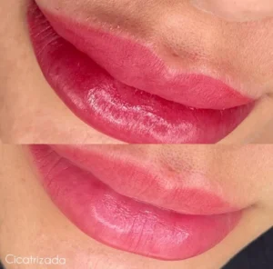 02 - IMG - Antes e depois - Neutralização - (Studio Hannayara)