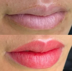 04 - IMG - Antes e depois - Neutralização - (Studio Hannayara)