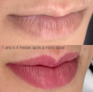 05 - IMG - Antes e depois - Neutralização - (Studio Hannayara)