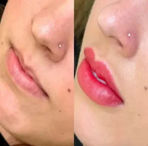 06 - IMG - Antes e depois - Neutralização - (Studio Hannayara)